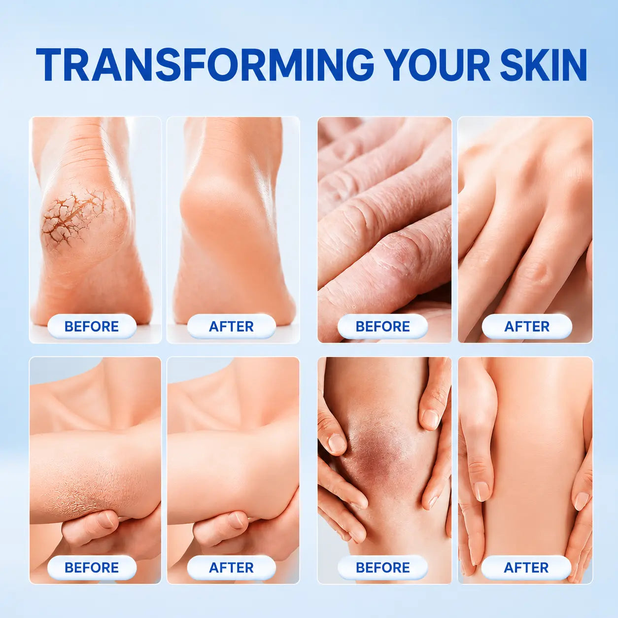 Cracked Skin Repair Cream