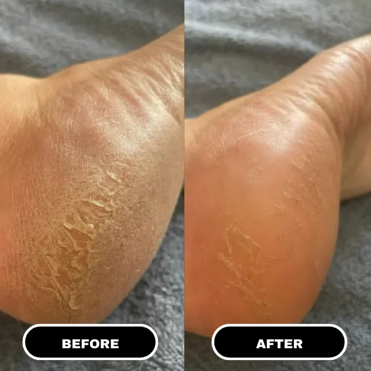 Cracked Skin Repair Cream